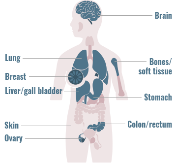 Distribution of ROS1 gene fusions across primary tumor sites graphic